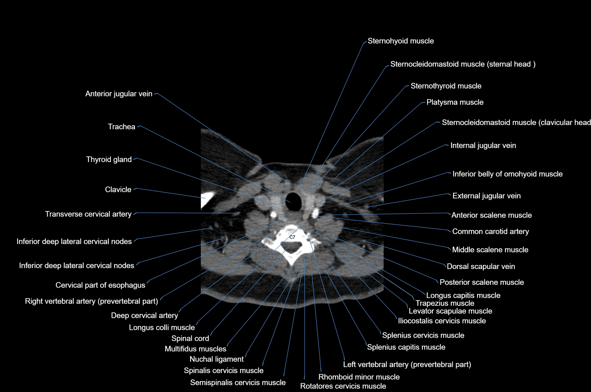 CT Neck axial cross sectional anatomy radiology image-img-00001-00048.webp